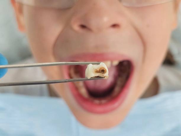 Best Emergency Treatment for Oral Infections in Calverton, MD